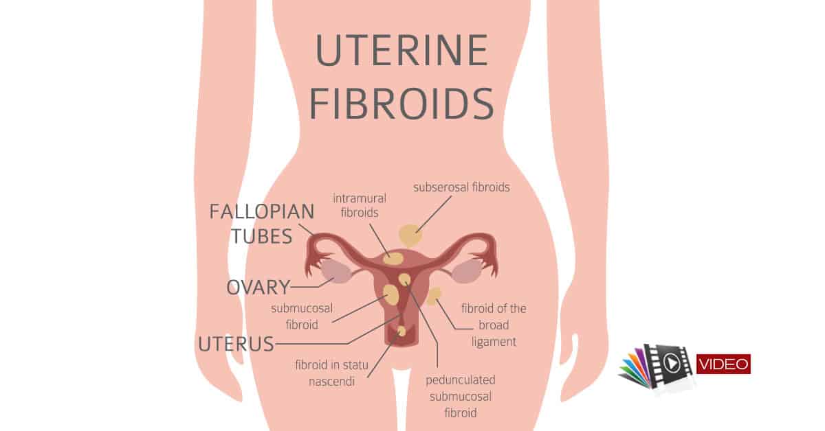 Tipuri de fibrom uterin, localizare, simptomatologie