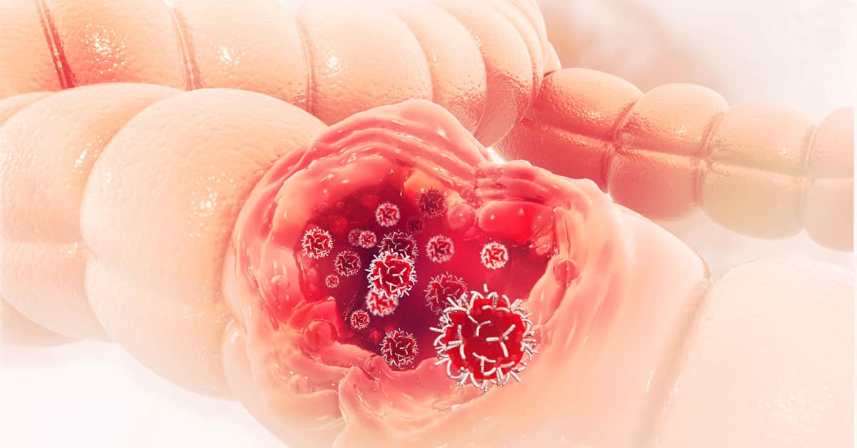 Semne și simptome ale cancerului de colon la bărbați