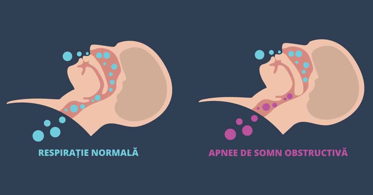 Apneea de somn – condiție premergătoare altor afecțiuni mai grave