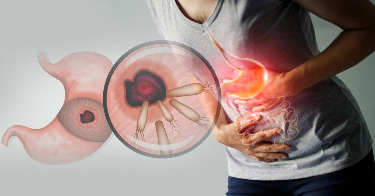 Gastrita atrofică – proces patologic ireversibil