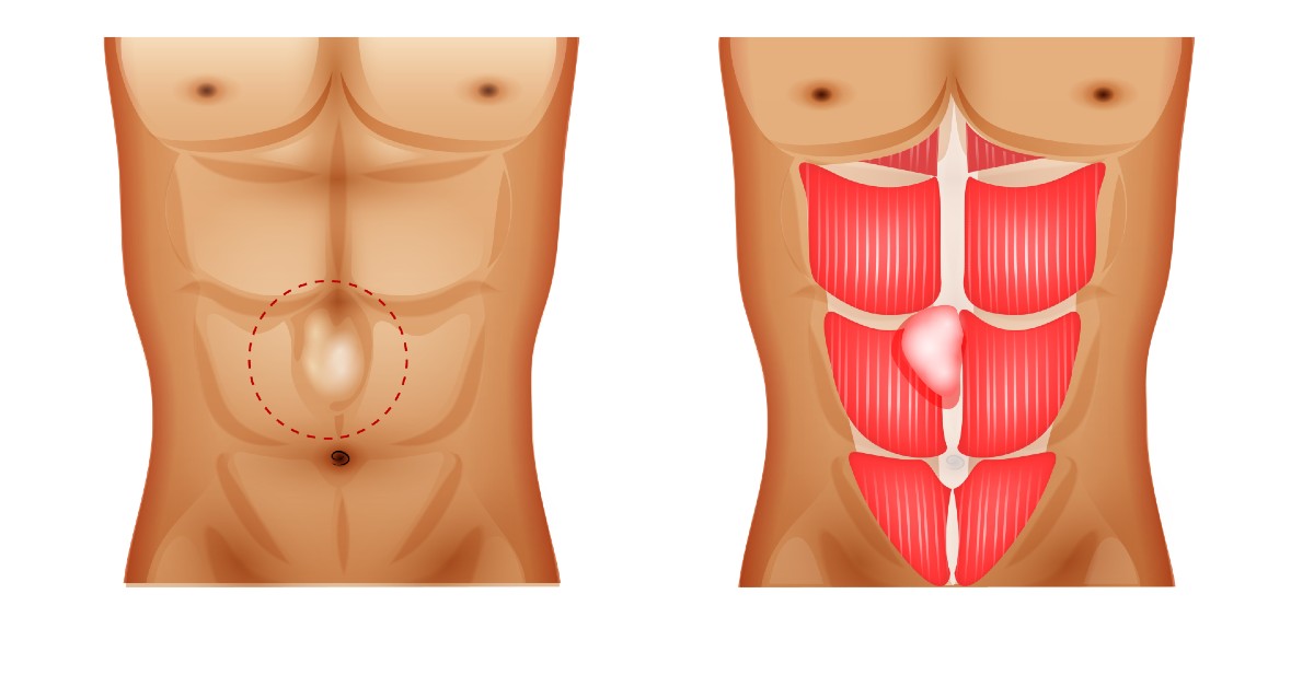 Hernia ombilicală, pe înțelesul tuturor