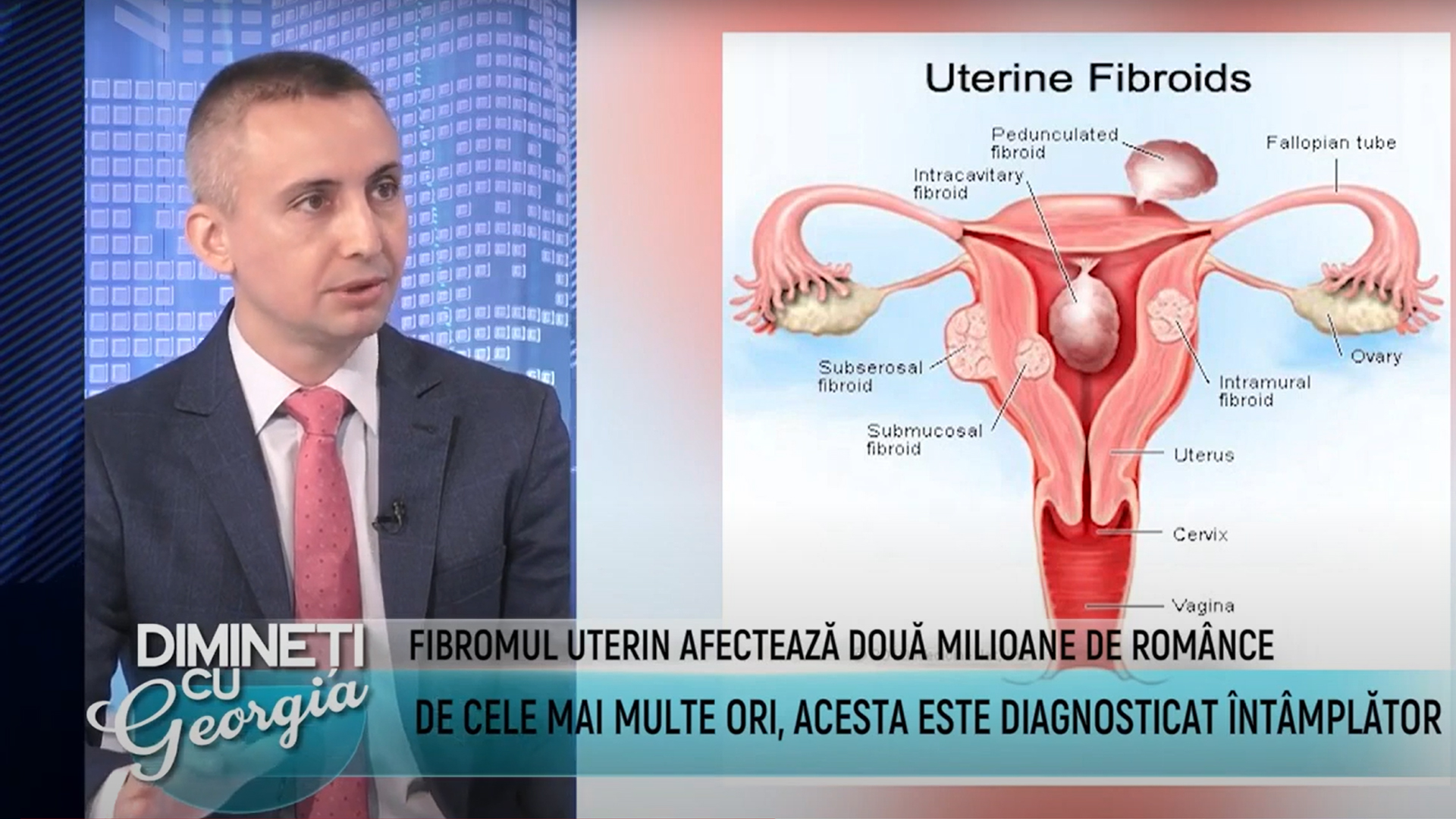 Despre Fibromul Uterin cu Dr. Cristian Jumuga